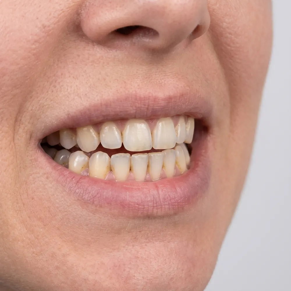Close crop of a smile showing the front teeth before and after alignment and whitening — before