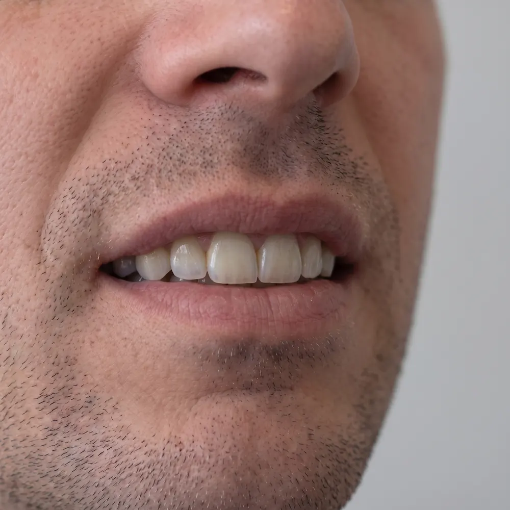 Close crop of a smile showing worn front edges and a gap before and after composite bonding — after