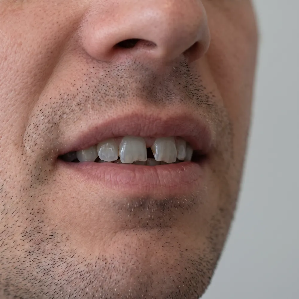 Close crop of a smile showing worn front edges and a gap before and after composite bonding — before